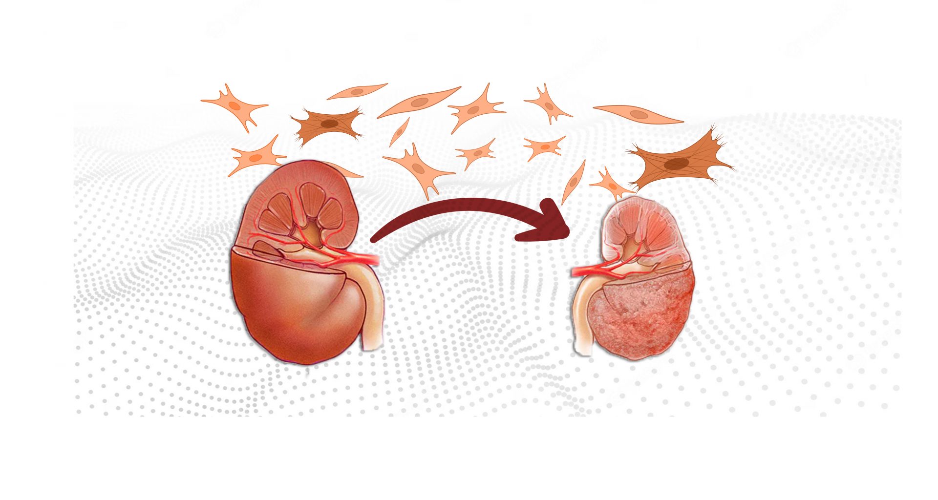 Chronic Kidney disease and fibrosis